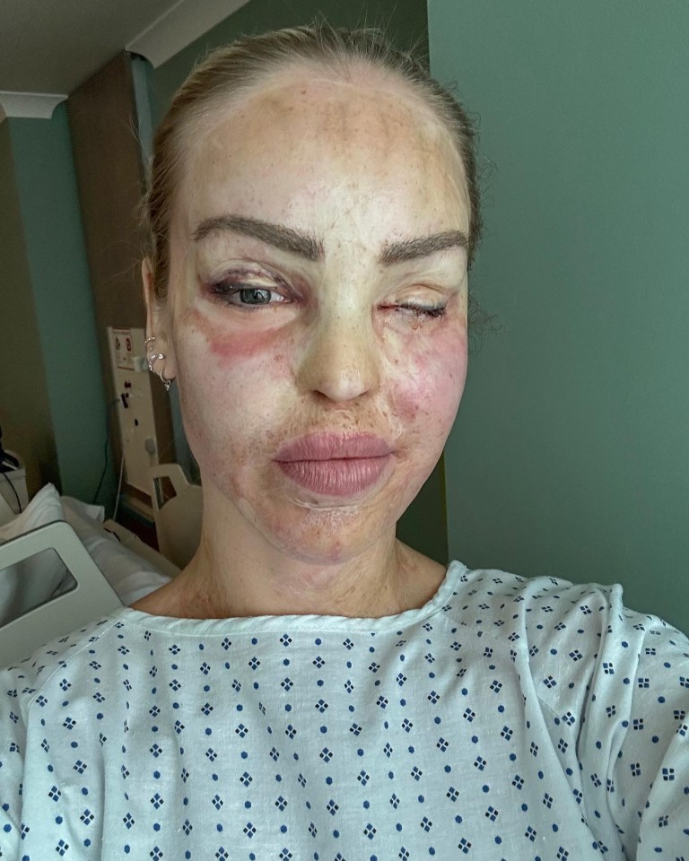 Katie Piper has had surgery to save her left eye