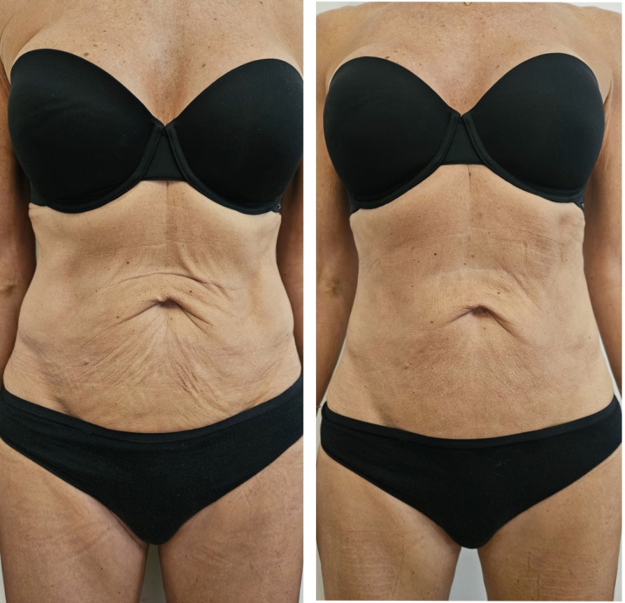 A GELIDA client's astonishing before and after photos after just one session