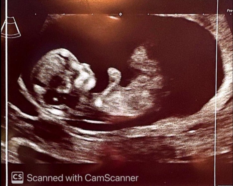 The EastEnders star shared the baby scan photo with his fans