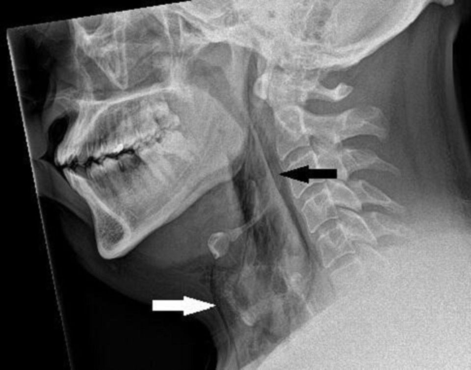 A man in Scotland tore a hole in his throat after holding in a sneeze, doctors have revealed