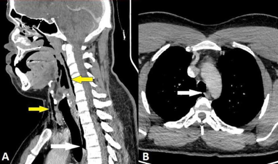 In the first known case of its kind, he ripped a small hole between the third and fourth bones of his neck