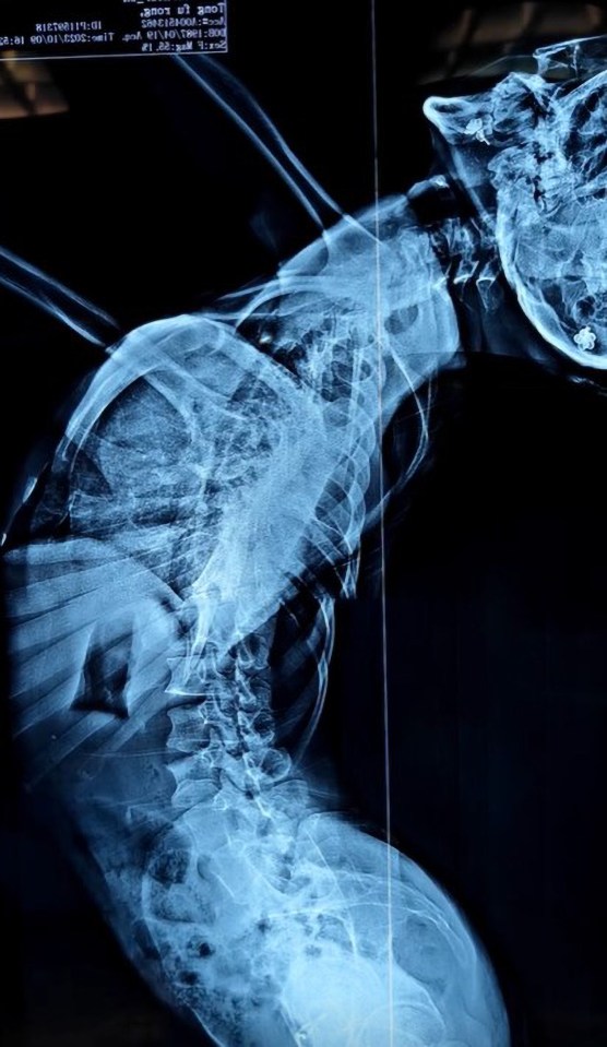 An X-ray of the woman's spine before the operation