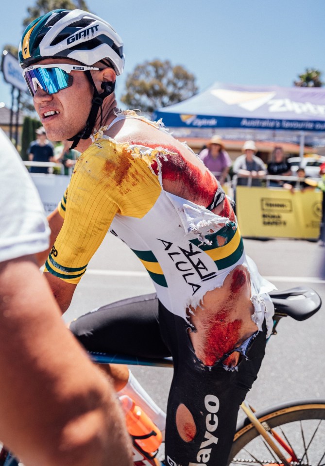 Australian cyclist Luke Plapp suffered gruesome injuries at the Tour Down Under