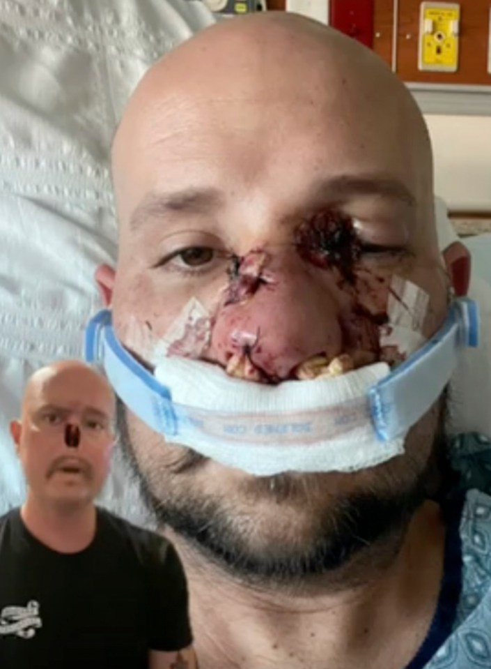 Brandon in hospital with his infected nose (right), Brandon without a nose (left)