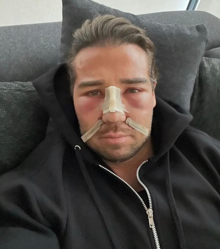 The reality star fractured his nose and eyes after taking part in The Challenge