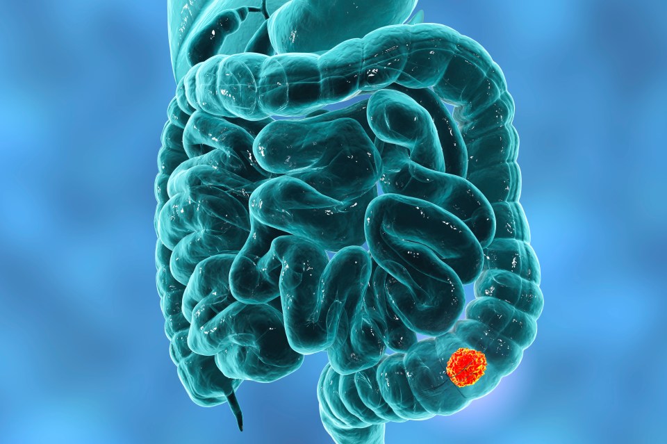 Colon cancer, computer illustration.