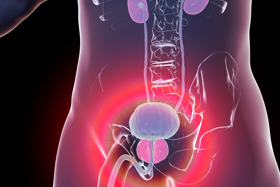 Around one in three men over 50 will develop an enlarged prostate, which sits behind the bladder