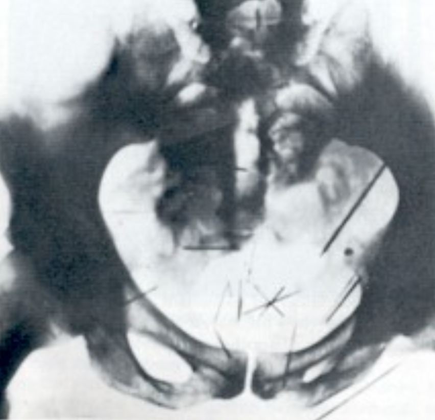 An X-ray of Fish's pelvis showing needles he had inserted into himself