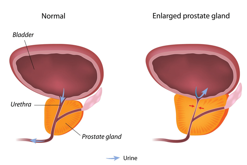 An enlarged prostate is common in men over the age of 50