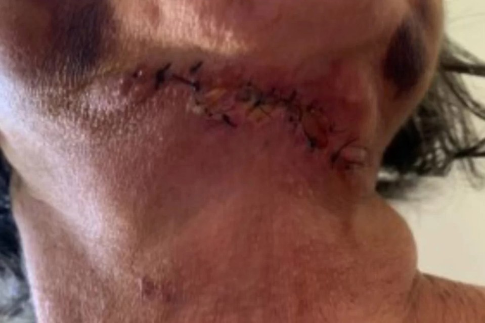 A third victim has a Frankenstein-like jagged scar across her neck