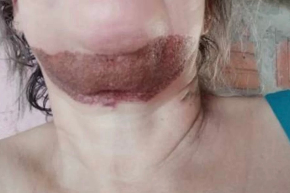 A horrific raw wound is seen on an alleged patient's chin