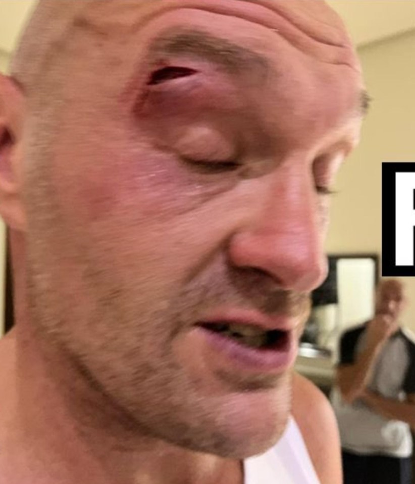 Tyson Fury’s cut that postponed the fight