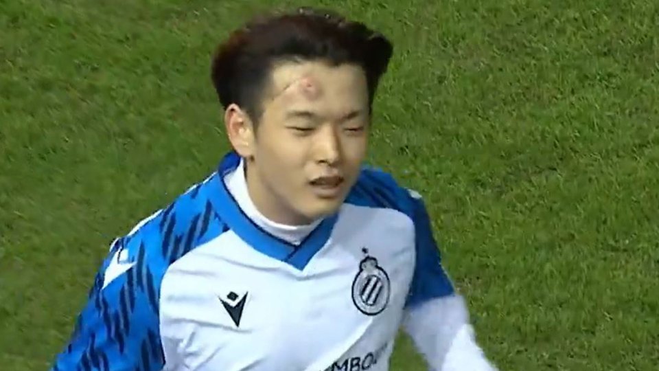 Shion Homma was left with a massive bruise on his head after running into a stancion