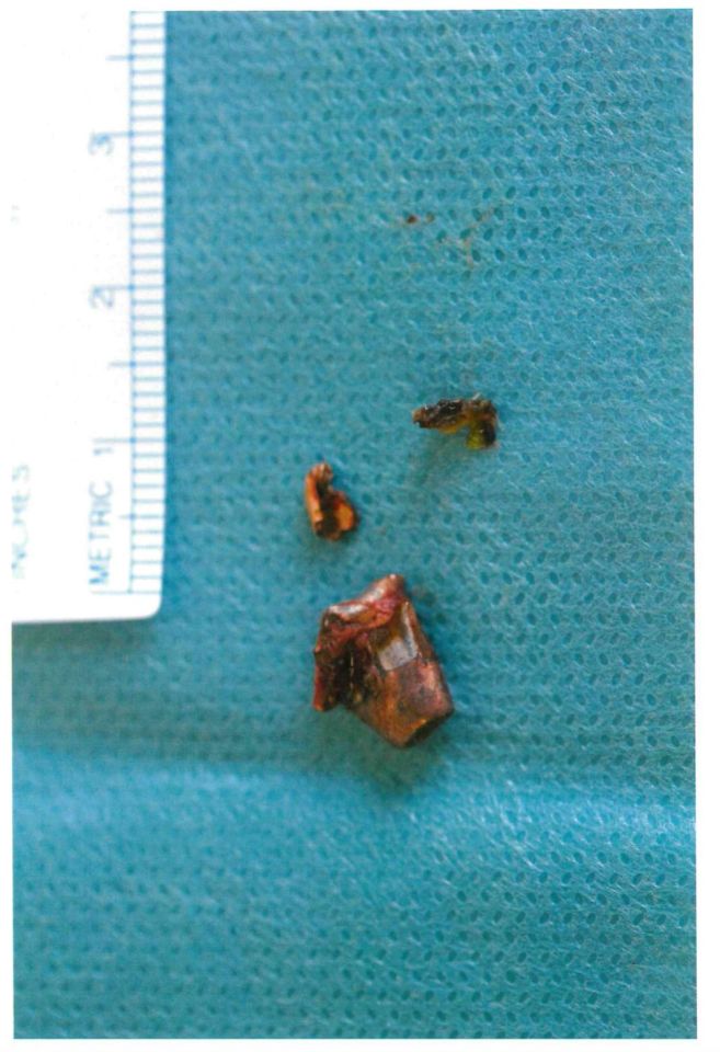 The bullet removed from Iryna's skull