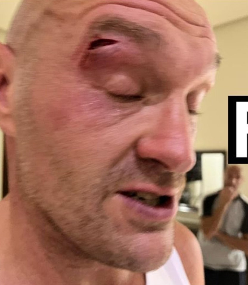 Tyson Fury's horror cut that postponed the Usyk fight