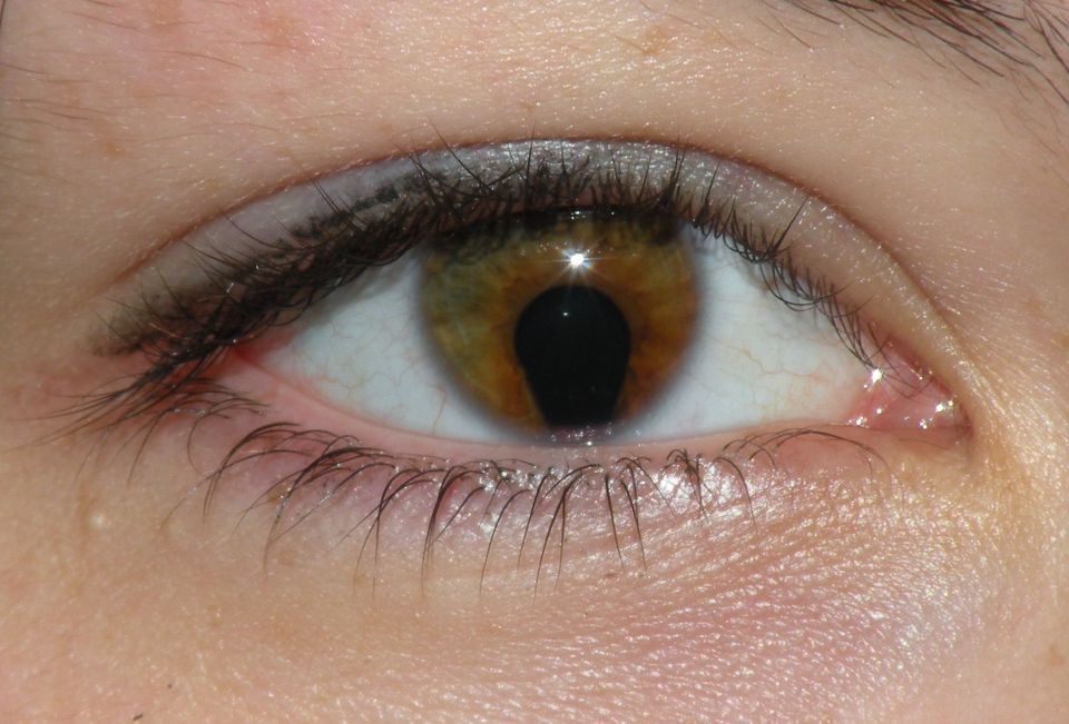  The most common form of coloboma makes a person's pupil look like a keyhole - rather than a round shape