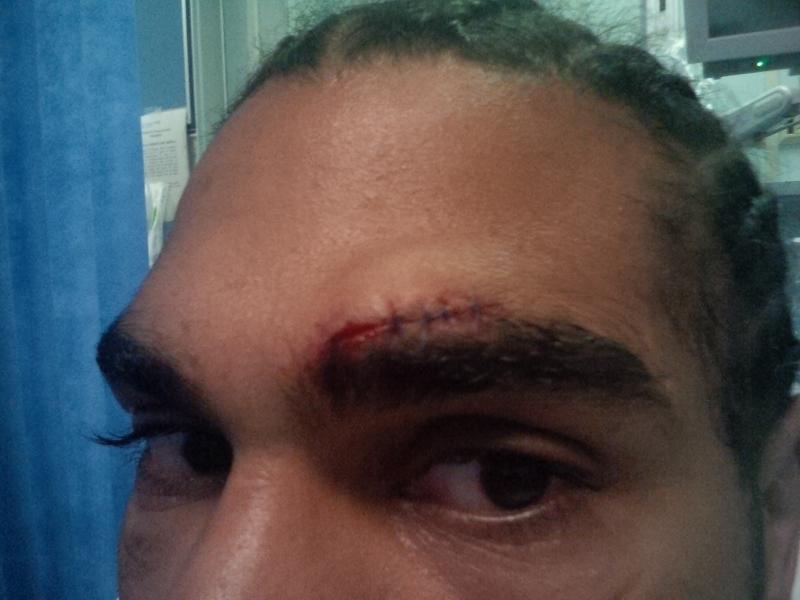 The Hayemaker was forced to pull out of the fight with a huge cut