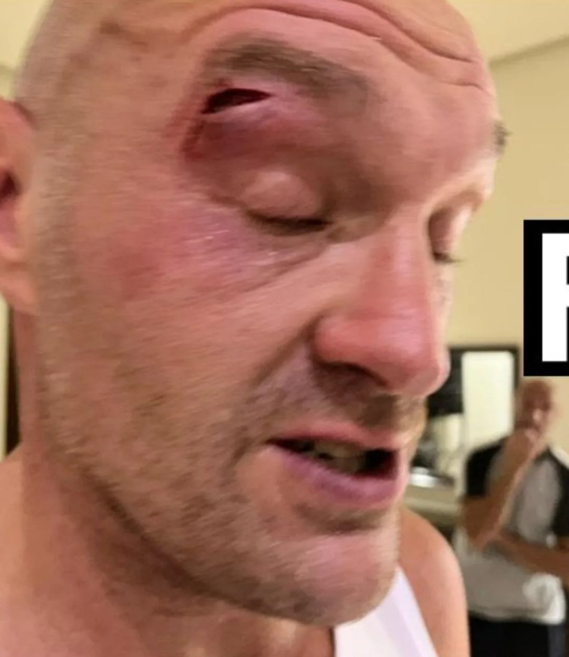 Fury pulled out of the bout after suffering a cut to the face