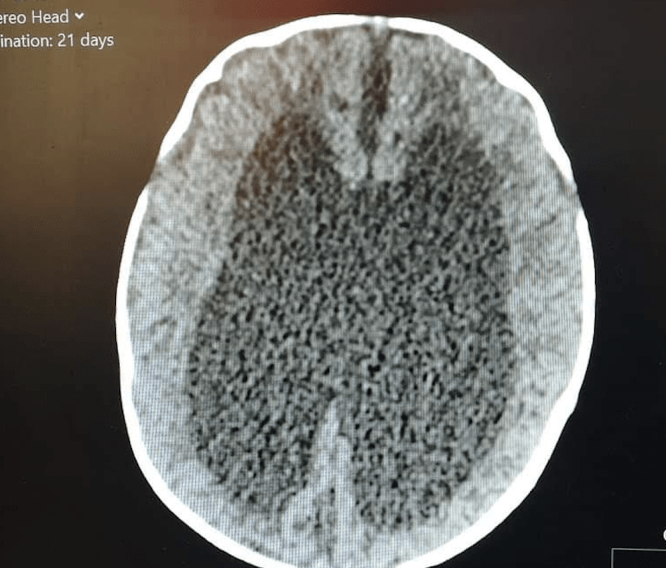 A scan showed fluid on baby Silver’s brain, leaving her with disabilities