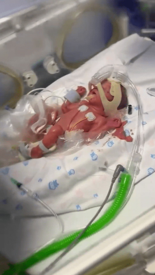 Baby Dustin was born 12 weeks prematurely and treated in an incubator