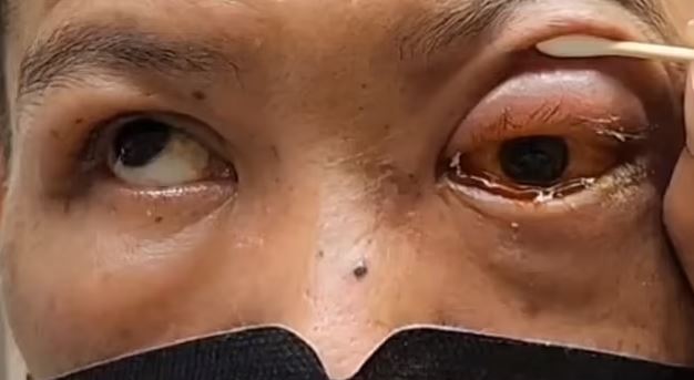 A man in Taiwan went permanently blind in one eye after a night of binge drinking and falling asleep face-down