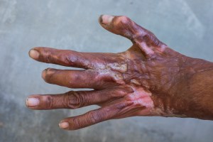 Acid burns can take years to heal