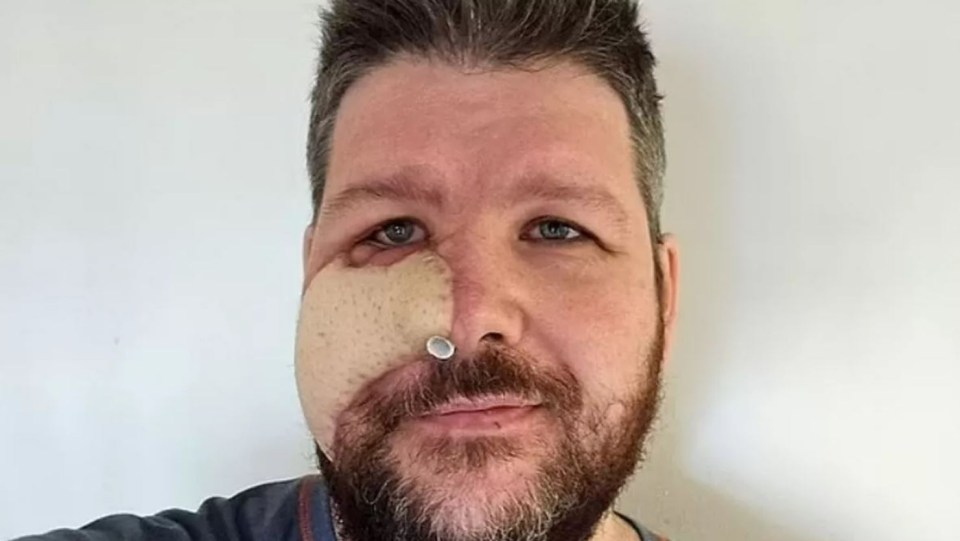 A Swedish father has had to have his face reconstructed after he was mauled by a bear