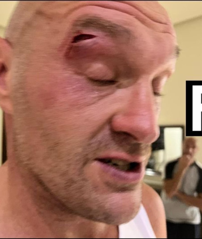 Fury's undisputed clash with Usyk was postponed after he suffered a horror cut this week