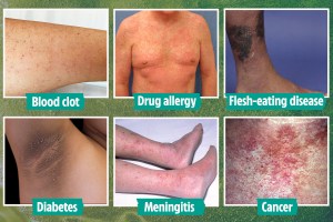  Most rashes are harmless, but some can be deadly