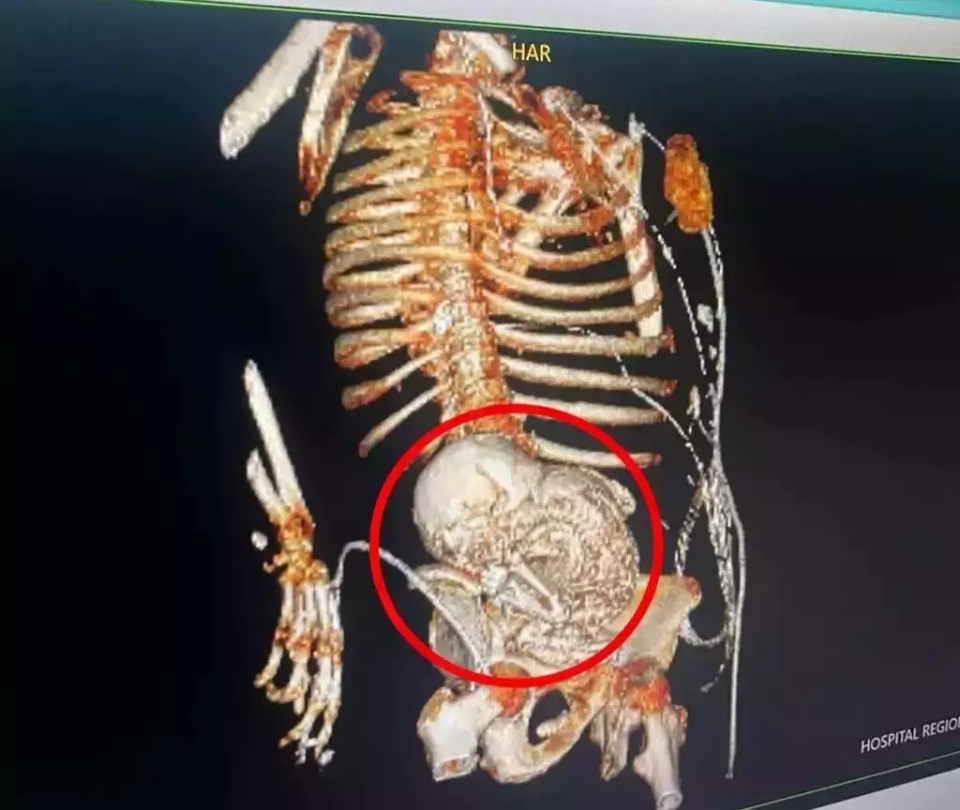 3D CT scans showing the lithopedion in Daniela's stomach