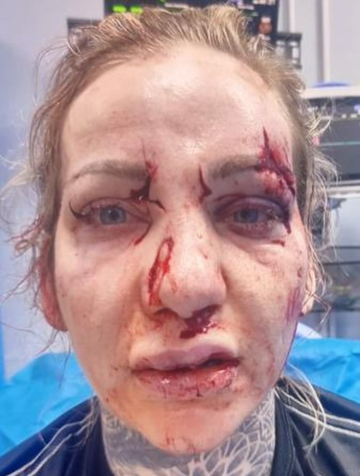 The horror crash left her with a broken nose and severe facial fractures