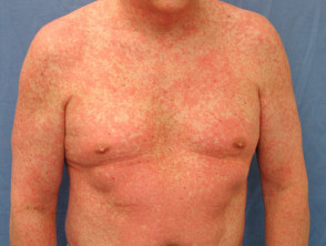  Drug hypersensitivity syndrome can also cause a red rash