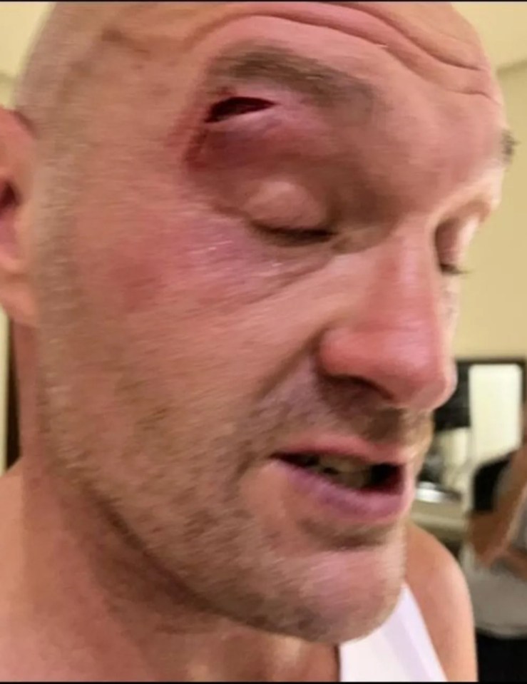 The cut that forced Tyson Fury out of the Oleksandr Usyk fight