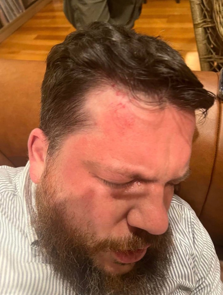 Picture showing Leonid Volkov's swollen face after the horror attack