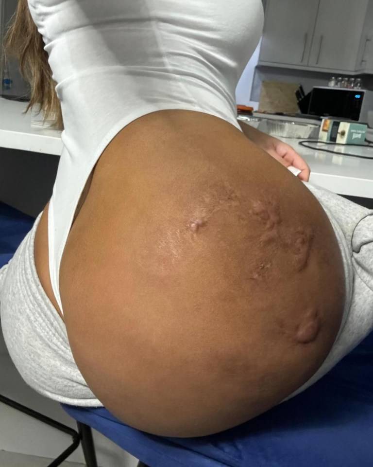 The scars left by Monique’s BBL