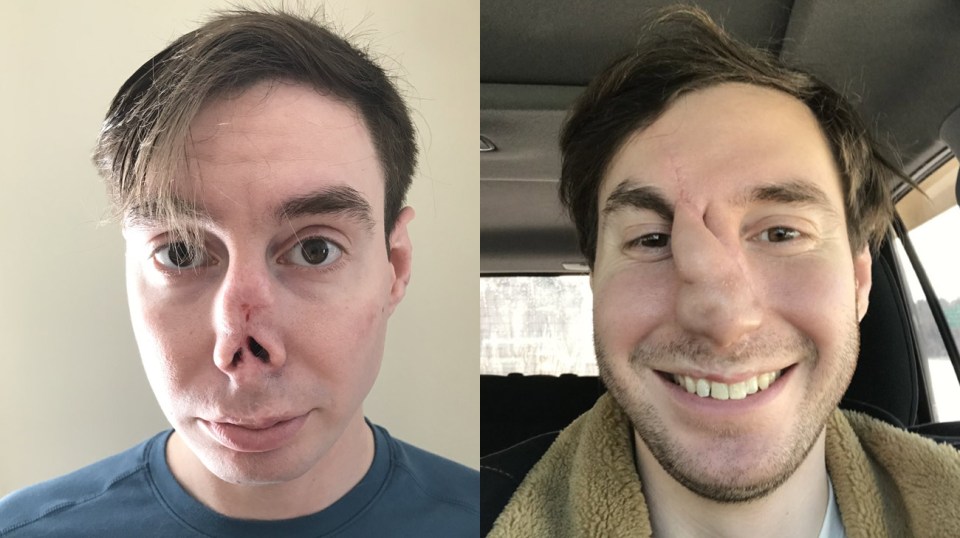 Andrew (pictured left, before the surgery, and right, during the middle of the process) had 14 surgeries over four years