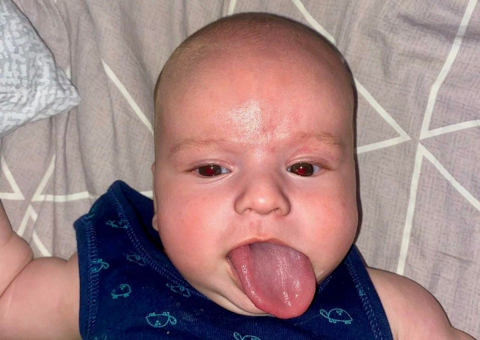 Lev from Odesa, Ukraine, whose tongue was five times longer than normal due to a rare syndrome