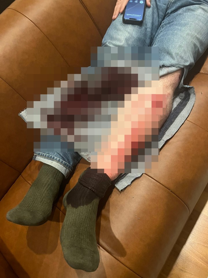 The political activist suffered severe injuries in his hands and legs