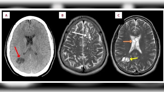 A man contracted a pig tapeworm that gave him migraines after eating undercooked bacon