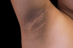  Acanthosis nigricans refers to darkened, thickened patches of skin that usually develop in the armpit, groin and neck