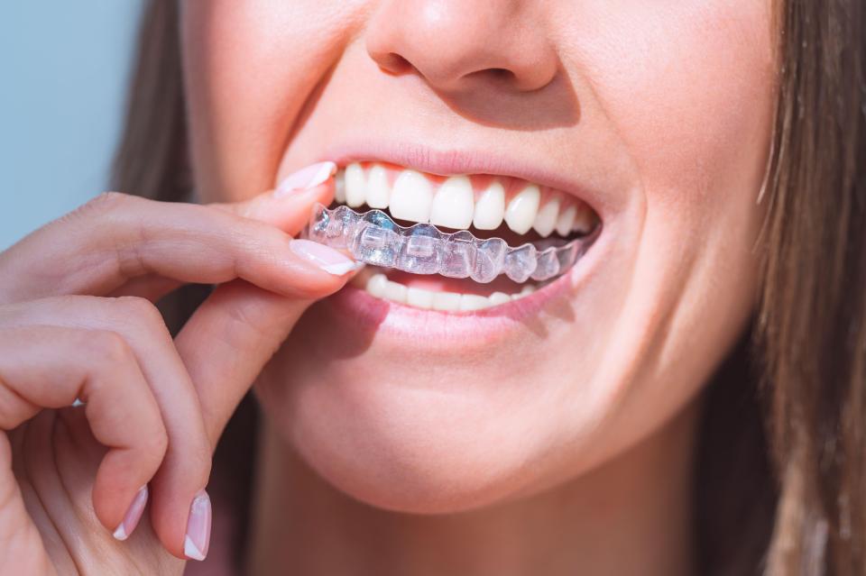 A dentist can give you dental trays fitted to your teeth for whitening