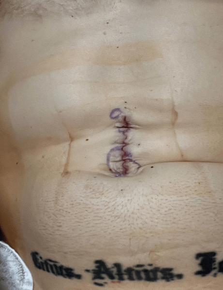 He recently revealed his stomach scar after abdominal surgery