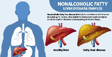 Nonalcoholic Fatty Liver Disease (NAFLD) a buildup of fat in the liver