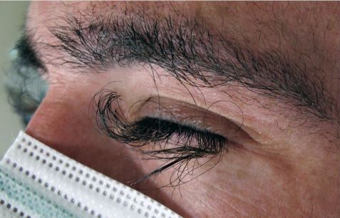 A man’s eyelashes became overgrown and curly because of cancer treatment