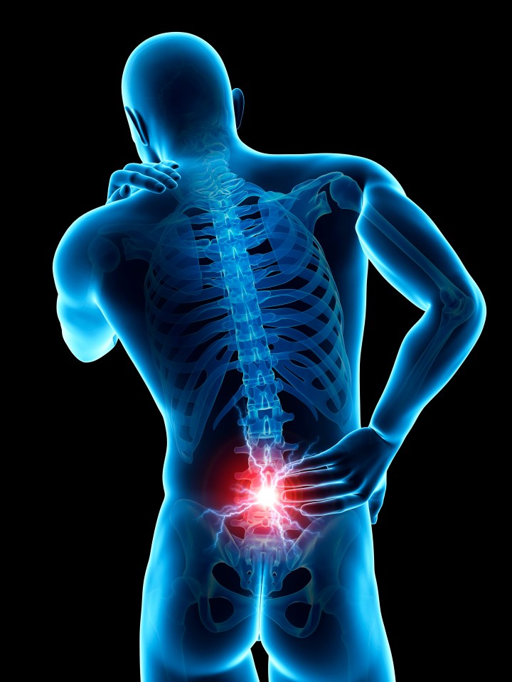 More serious causes of lower back pain include a slipped disc, which also causes numbness, tingling or muscle weakness