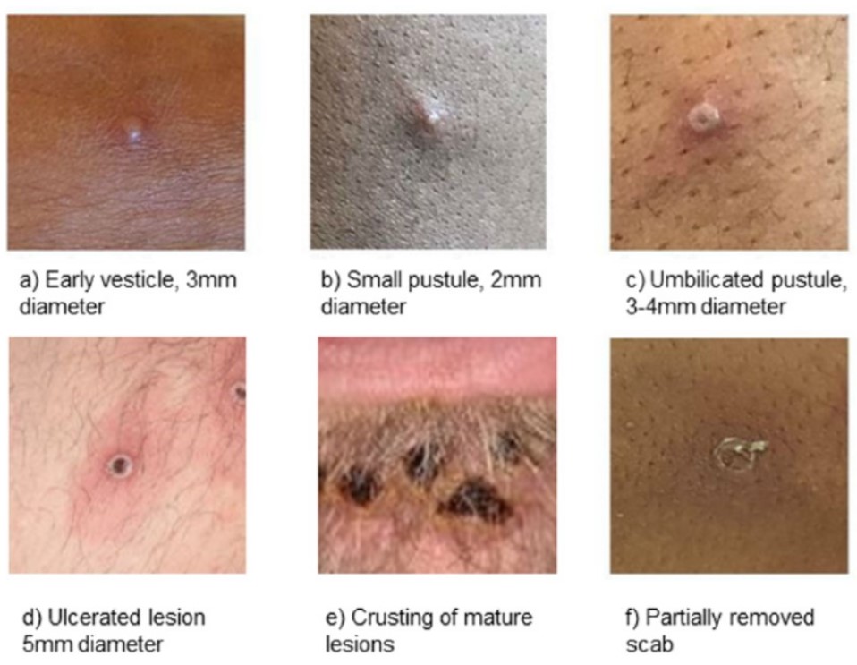 The skin rash or pus-filled lesions can last two to four weeks