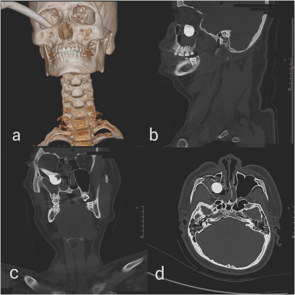 Scans show a brake handle lodged in teen’s eye socket after a horror crash