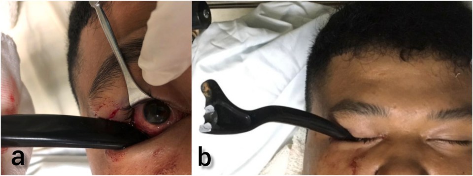 Doctors had to pull a motorcycle brake handle from a teenager’s eye