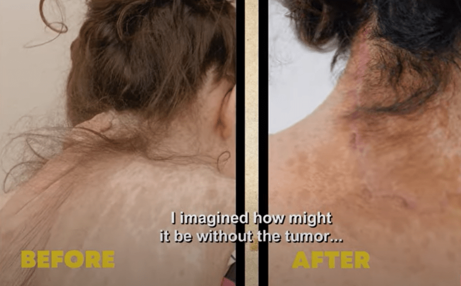 The only remnant of the tumour is a scar running down Alexandra's neck to her collarbone