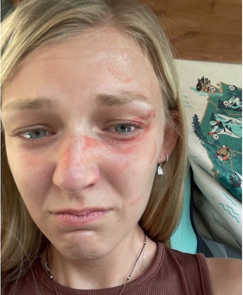 Gabby’s face was bruised when the couple were stopped by police